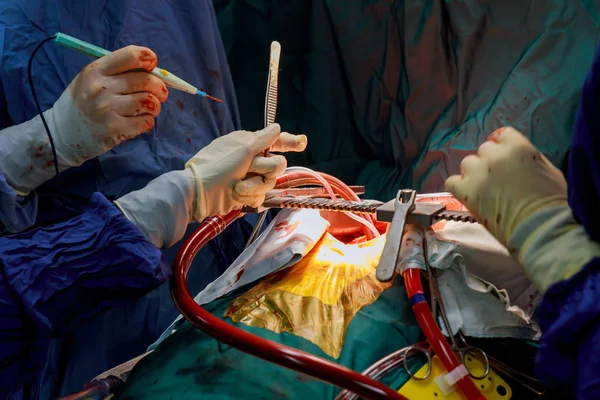 心を開いて操作中に手術器具と外科医 — ストック写真