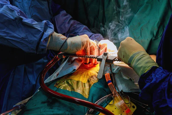 Cirugía y equipo de cirujanos realizan cirugía torácica en caso de cáncer de pulmón — Foto de Stock
