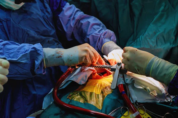 Varrat egy tüdő emphysema műtét egy csecsemő, orvosi segítséget közelről — Stock Fotó