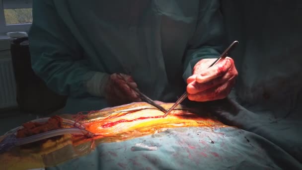 Wire seams with many surgical clamps close-up after the cardiac surgery — Stock Video