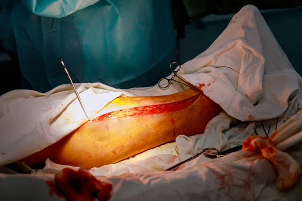 Equipo de cirugía de piernas trabajando en el quirófano — Foto de Stock