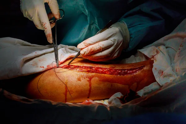 Operation of varicose veins leg surgery by surgeon in operating room — Stock Photo, Image