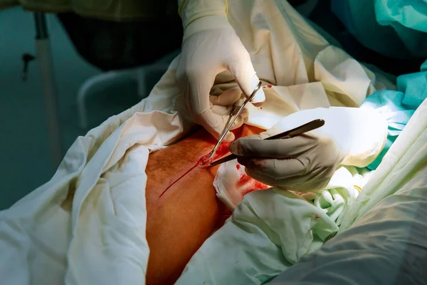 수술실에 기구를 가지고 의사가 환자의 다리를 수술하고 메스로 피부를 — 스톡 사진
