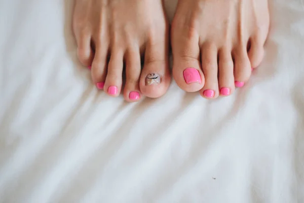 Women's legs. The damaged nail. Problems with the nails. Painted nails — Stock Photo, Image