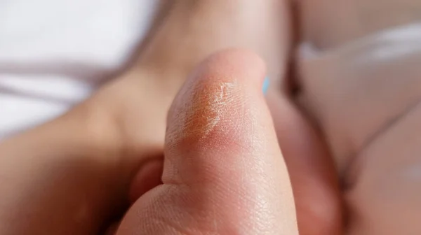 Close up of a dry foot