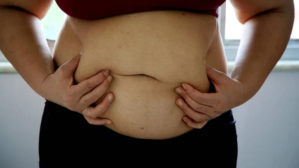 Salvador Bahia Brazil June 2020 Woman Holds Her Belly Accumulation — Stock Photo, Image