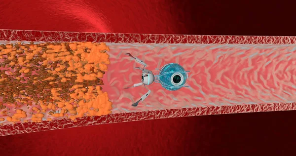 O nanorobot removeu placas de colesterol. Conceito do futuro. Renderização 3D — Fotografia de Stock