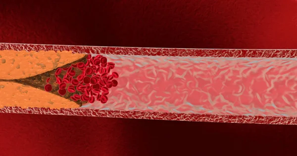 Rendering 3D del vaso sanguigno bloccato — Foto Stock