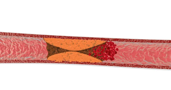 Заблокована 3D візуалізація кровоносних судин — стокове фото