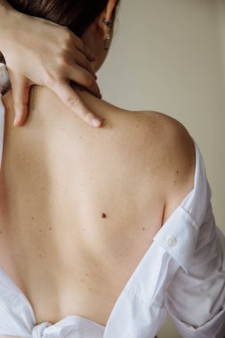 Küçük ve büyük benli beyaz bir kızın arkası.. 