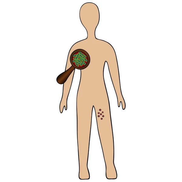 Formación Buboes Como Resultado Infección Con Una Enfermedad Infecciosa Aguda — Archivo Imágenes Vectoriales