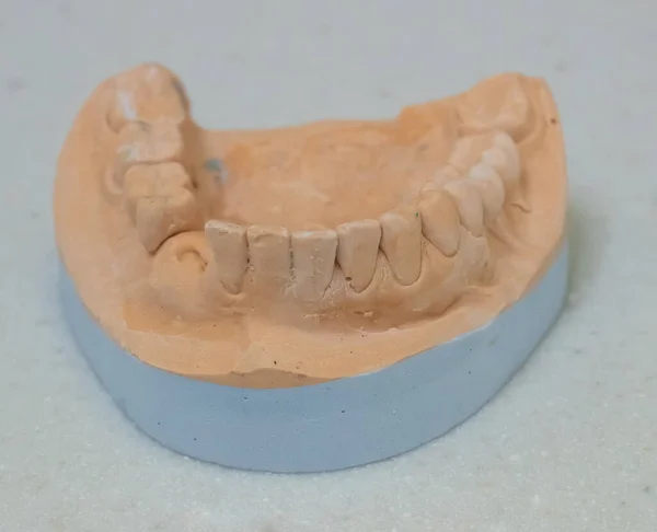 Modello Gesso Denti Manca Dente — Foto Stock