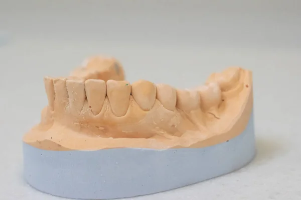 Modello Gesso Vista Laterale Dei Denti Ortopedia Odontoiatria — Foto Stock