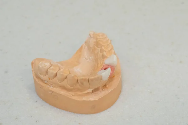 Plaster Models Teeth Veneers — Stock Photo, Image
