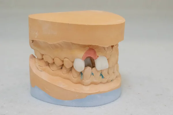 Lower Upper Jaw Plaster Model — Stock Photo, Image