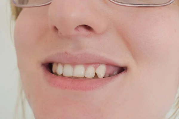 Посмішка Криві Навіть Зуби Дівчини — стокове фото
