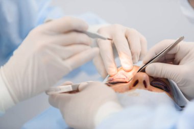 Blefaroplasti, plastik cerrahi operasyon kusurları, deformiteleri ve göz kapakları disfigurations düzeltmek ve estetik yüz göz bölgesini değiştirmek için. tıbbi klinikte