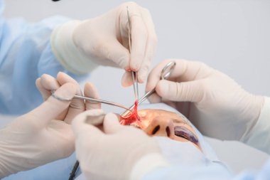 Blefaroplasti, plastik cerrahi operasyon kusurları, deformiteleri ve göz kapakları disfigurations düzeltmek ve estetik yüz göz bölgesini değiştirmek için. tıbbi klinikte