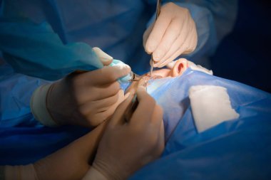 lazer Blefaroplasti, defektleri düzeltmek için plastik cerrahi operasyon, deformiteler, ve göz kapaklarının disfigurations; ve estetik olarak yüzün göz bölgesini değiştirmek için. tıbbi klinikte