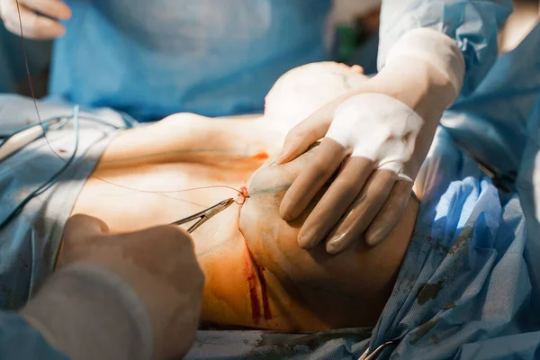 Cirurgião Inserir Implante Silicone Peito Mulher Mamas Aumentar Operação Plástica — Fotografia de Stock