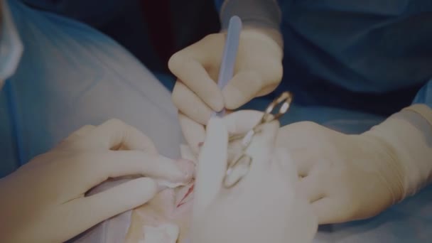 Блефаропластическая Операция Пластической Хирургии Изменения Области Глаза Лица Медицинской Клинике — стоковое видео