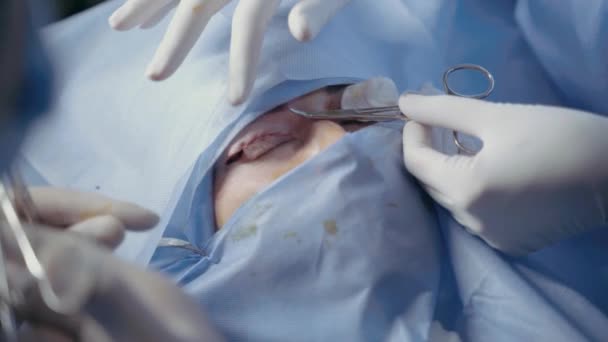 Блефаропластическая операция пластической хирургии для изменения области глаза лица в медицинской клинике. 2 врача делают пластическую операцию для женщины. Хирург зашивает веко — стоковое видео