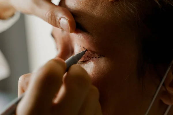 Blepharoplasty Markup Face Beautiful Female Plastic Surgery Operation Modifying Eye — Stock Photo, Image
