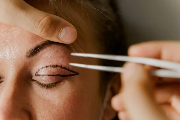 Blepharoplasty Markup Close Face Plastic Surgery Operation Modifying Eye Region — Stock Photo, Image