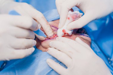 Tıbbi klinikte yüzünün göz bölgesini modifiye etmek için yakın plan blefaroplasti lipodoli ameliyatı. İki doktor kadınlar için estetik ameliyat yapıyor. Cerrah göz kapağına dikiş atar.