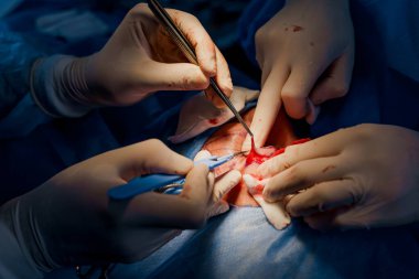 Tıbbi klinikte yüzünün göz bölgesini modifiye etmek için yakın plan blefaroplasti lipodoli ameliyatı. İki doktor kadınlar için estetik ameliyat yapıyor. Cerrah göz kapağına dikiş atar.