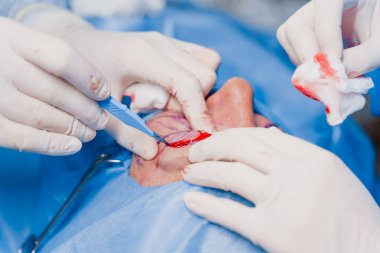 Tıbbi klinikte yüz bölgesinin değiştirilmesi için Blepharoplasty estetik ameliyatı. İki doktor kadınlar için estetik ameliyat yapıyor. Cerrah cerrahi bıçakla bir kesik atar.