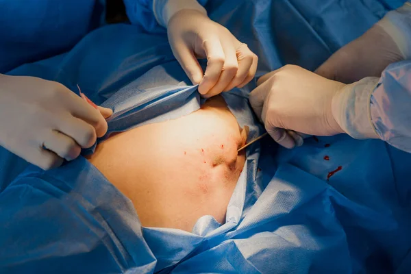 Liposukcja Operacji Lipofill Zbliżenie Zdjęcie Chirurga Zrobić Operację Plastyczną Nazwie — Zdjęcie stockowe