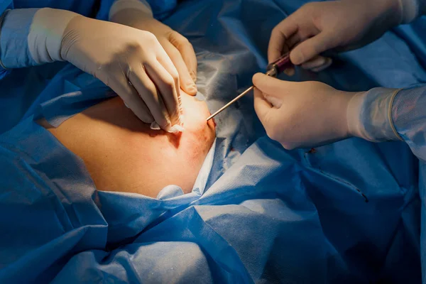 Zsírleszívás Lipofillingműtéthez Közeli Fotó Sebész Csinál Plasztikai Sebészet Nevű Blepharoplasztika — Stock Fotó