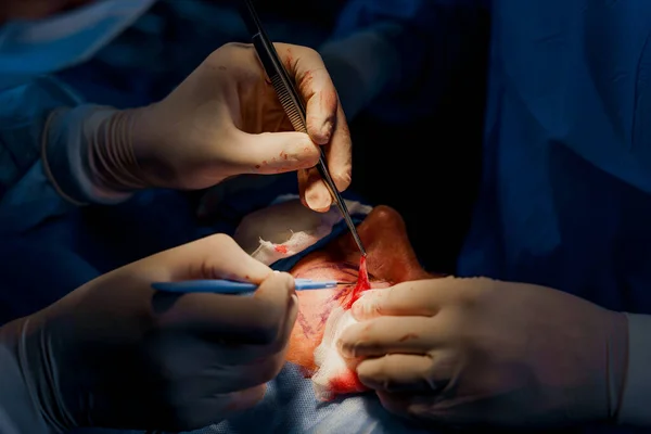 Närbild Blefaroplastik Lipofilling Plastikkirurgi Operation För Att Ändra Ögonområdet Ansiktet — Stockfoto