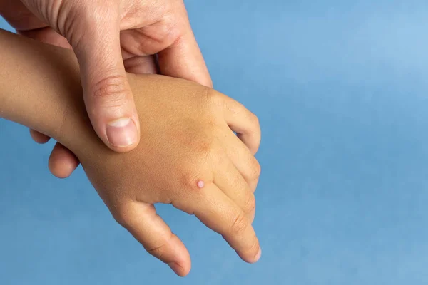 Verruga Común Dedo Del Primer Plano Mano Niño Copiar Espacio — Foto de Stock