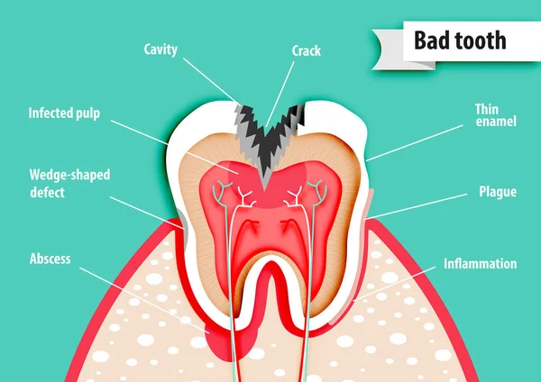 Arte Carta Scienza Della Salute Vettore Dente Cattivo — Vettoriale Stock