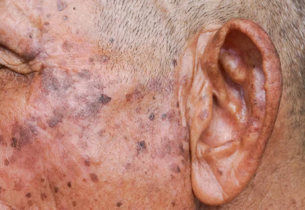 Old Asian Man Head Full Freckles Seborrheic Keratosis Seborrheic Verruca — Stock Photo, Image