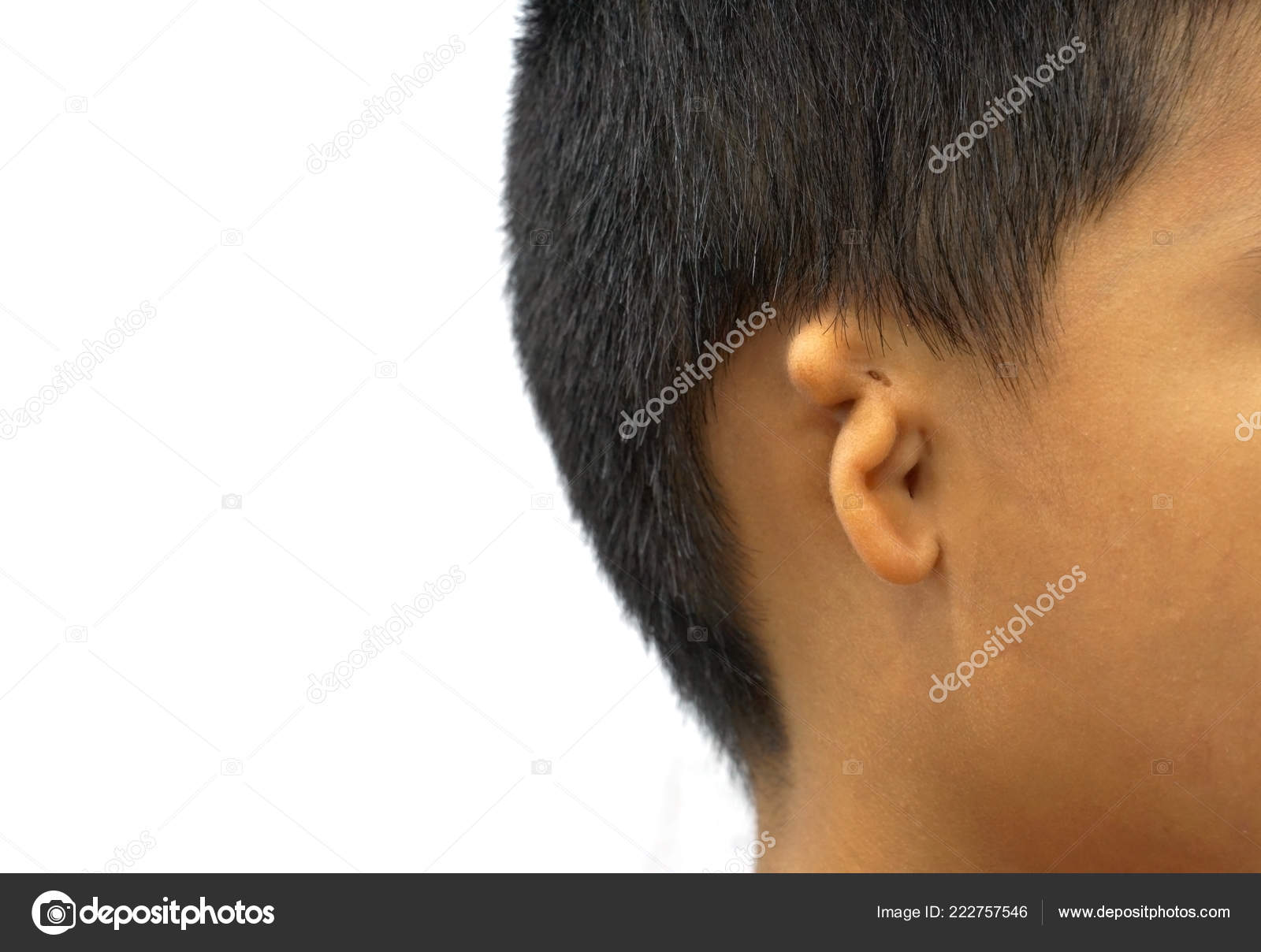 Microtia Congenital Deformity Pinna External Ear Underdeveloped Stock