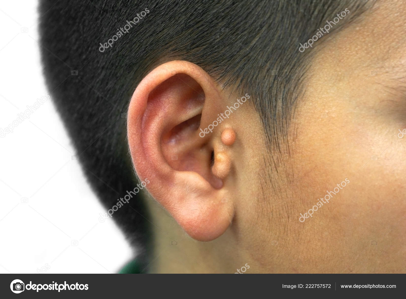 Pre Auricular Skin Tag Preauricular Tags Ear — Stock Photo ...