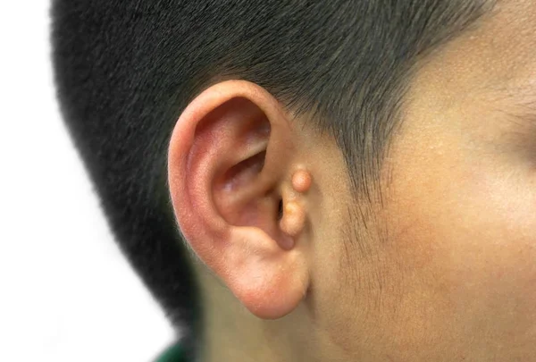 Pre Auricular Skin Tag Preauricular Tags Ear — 스톡 사진