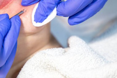 Özel muamele ile donanım yüz temizleme prosedürü.