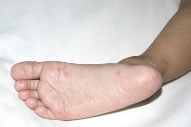 Allergic rash skin of baby's right foot clipart
