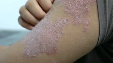 Döküntü psoriasis derisi çizilmemesi adamın elleri