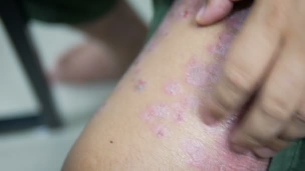 Handen Van Man Krabben Huid Uitslag Psoriasis — Stockvideo