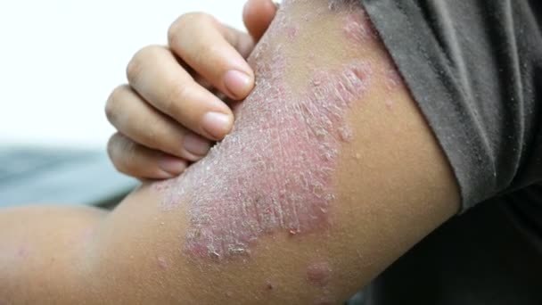 Handen Van Man Krabben Aan Arm Huiduitslag Psoriasis — Stockvideo