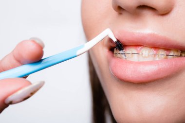 Kız dudakları ve diş fırçasıyla yakın plan, diş tellerini temizlemek için.