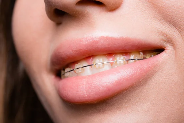 Primer plano de una chica sonriente con ortodoncia. Concepto de clínica dental para publicidad . — Foto de Stock