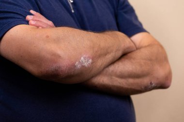 Ciltte dermatit, kötü alerjik döküntü dermatit egzama