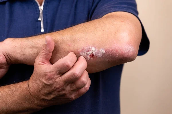 Ciltte dermatit, kötü alerjik döküntü dermatit egzama