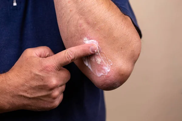 Concept photo of treatment of skin diseases using ointments as d — Stock Photo, Image